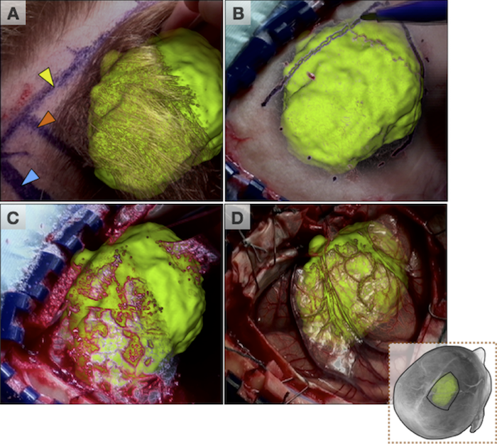 brain tumor surgery video